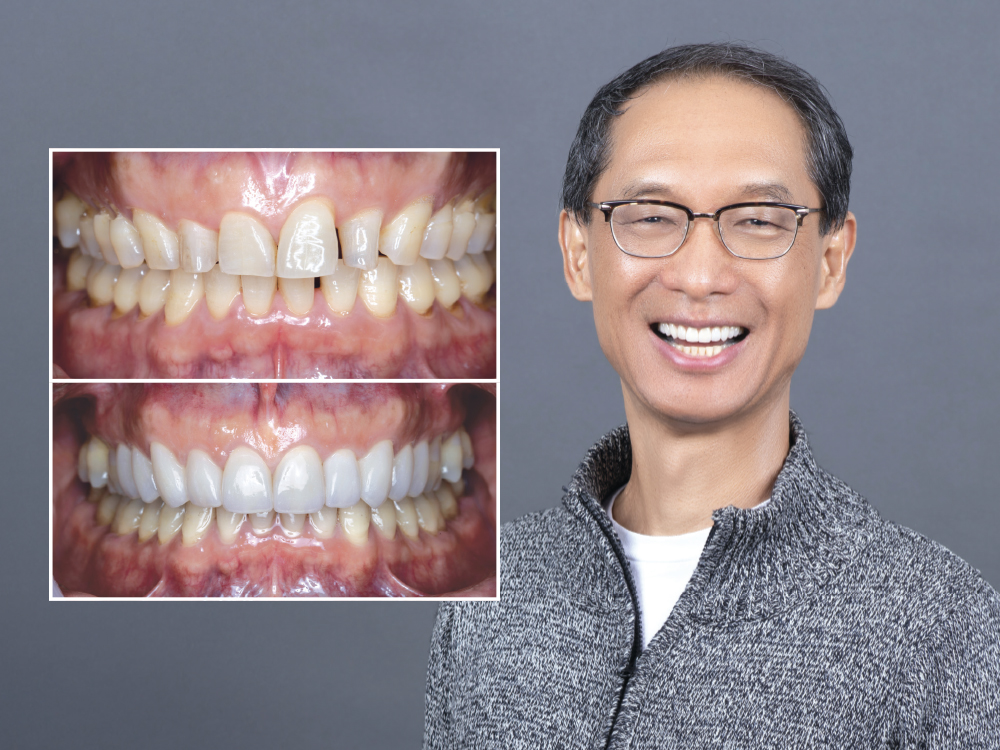 Dental before-and-after treatment comparison Dental before-and-after treatment comparison