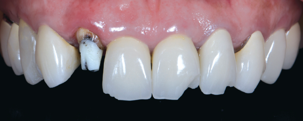 Close-up of dental implant and teeth