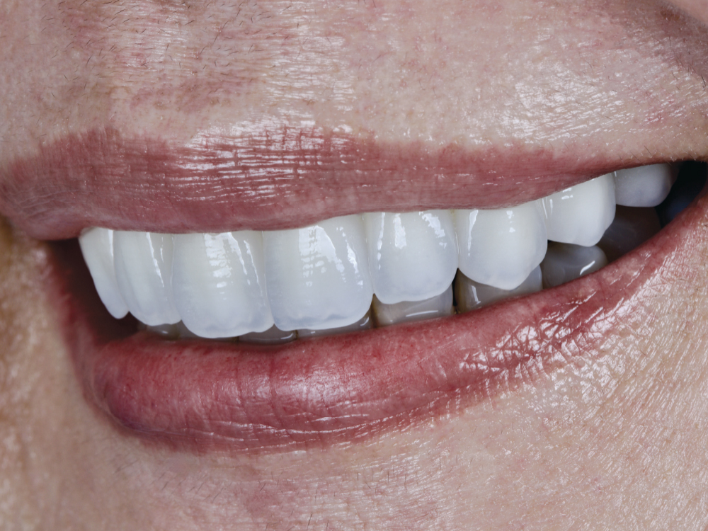 Close-up of smiling teeth with veneers