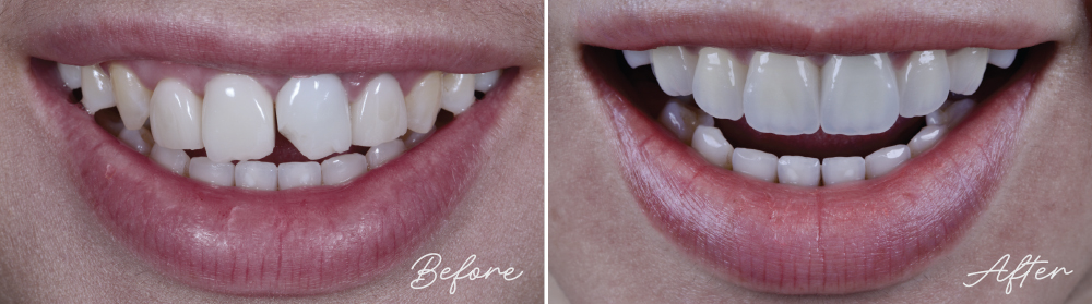 Before and after dental transformation
