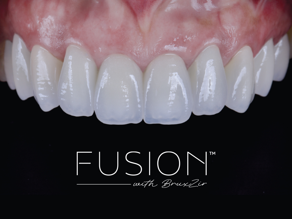 Close-up of dental veneers with Fusion branding