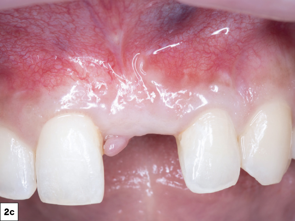 Close-up of missing front tooth and gums