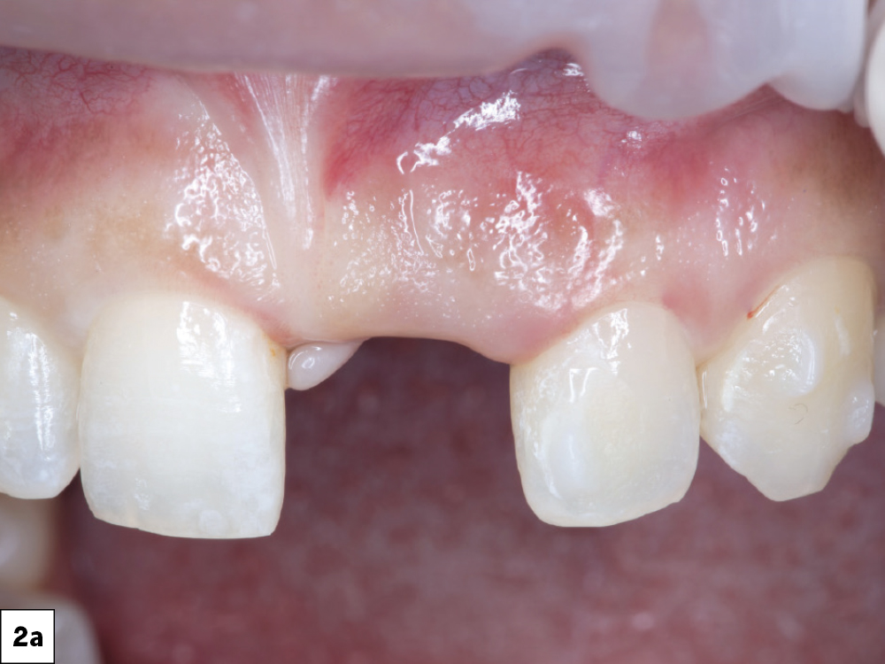 Close-up of gum inflammation and missing tooth