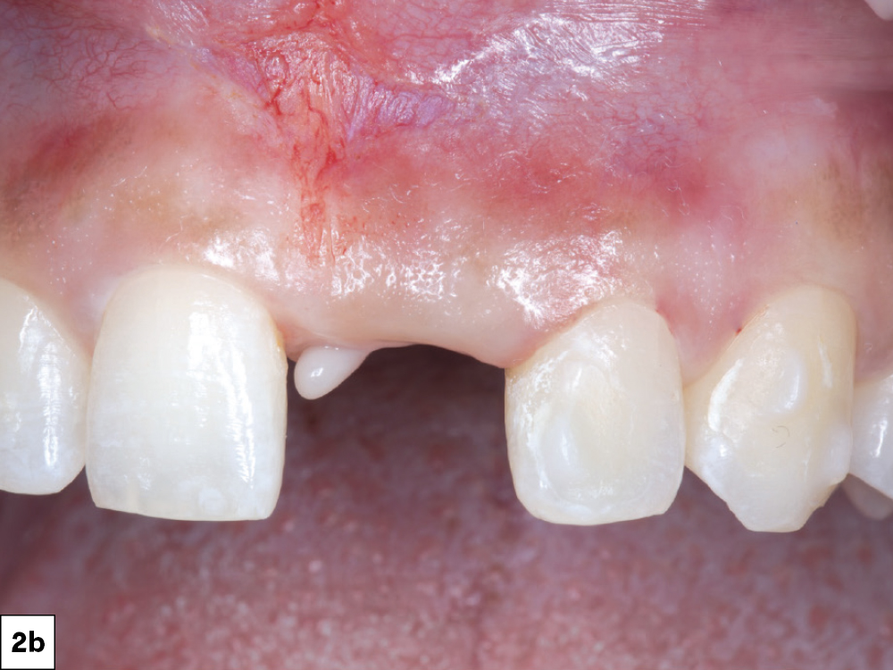 Close-up of dental gum injury