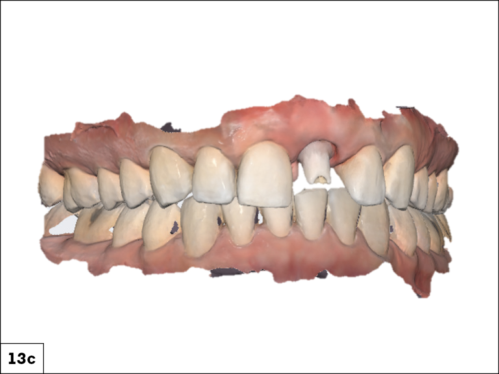 Dental model showcasing teeth alignment
