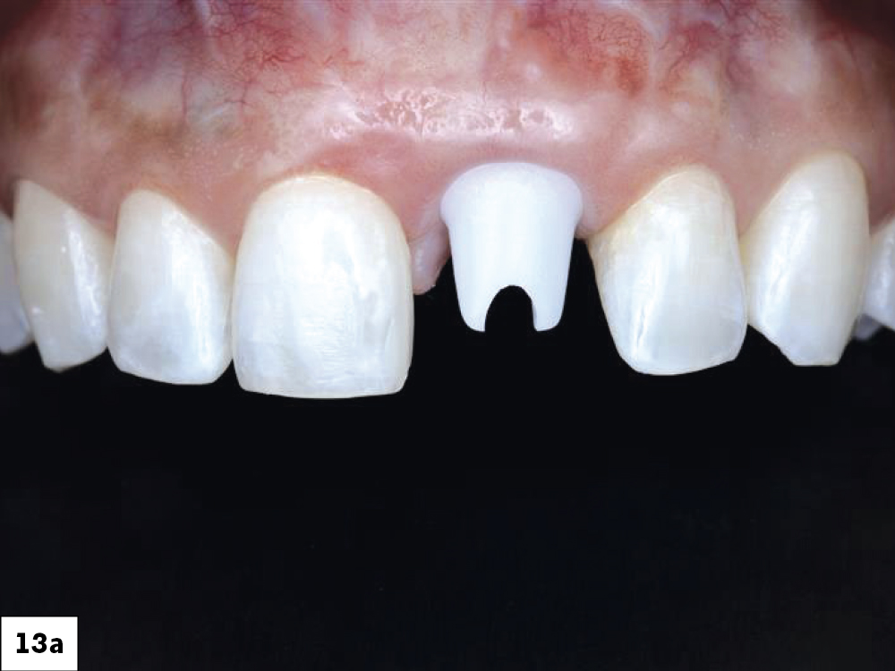 Dental implant close-up with missing tooth