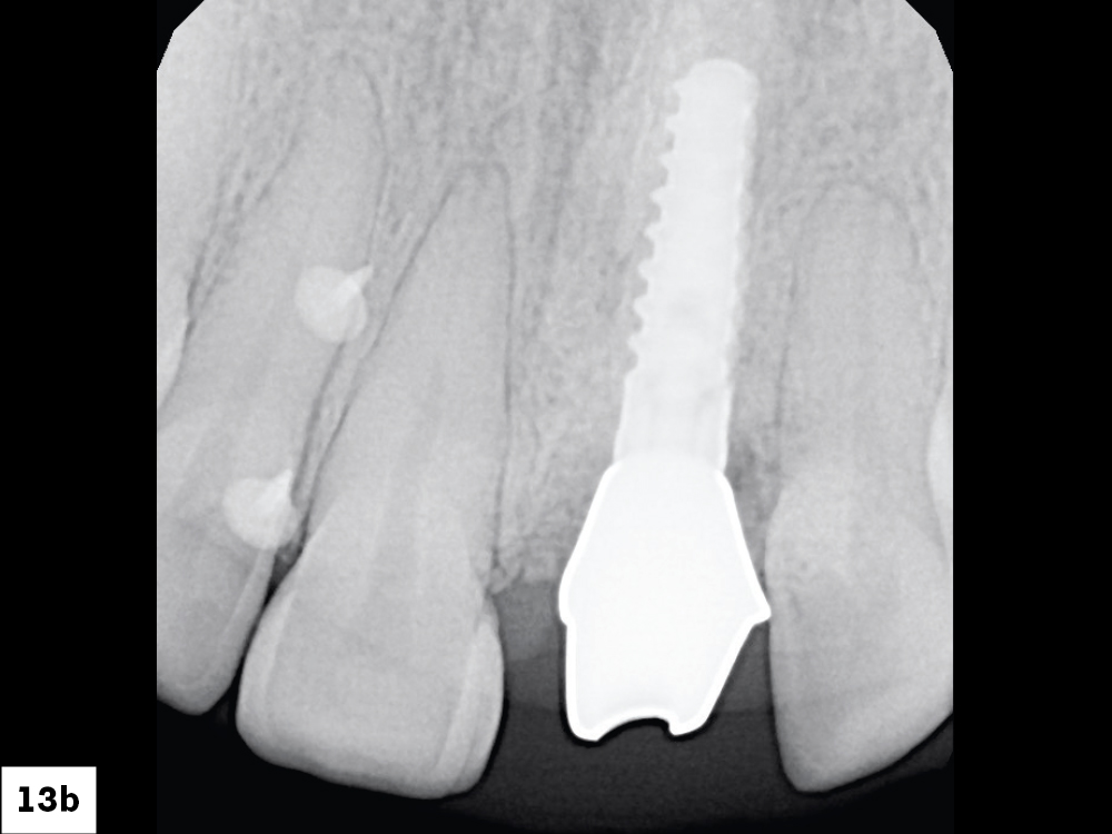 Dental X-ray showing implant and teeth