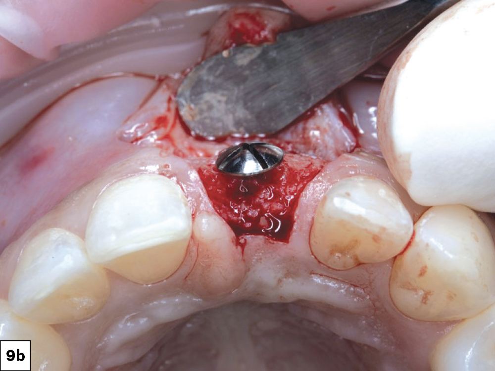 Implant placement 1