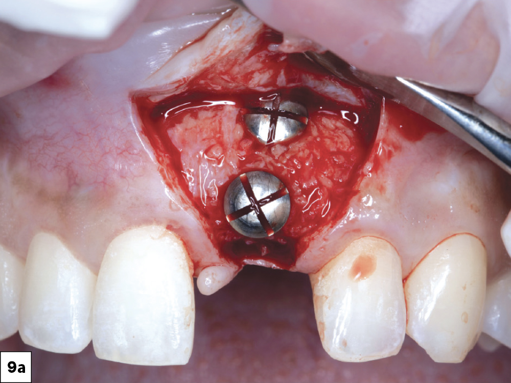 Implant placement 2