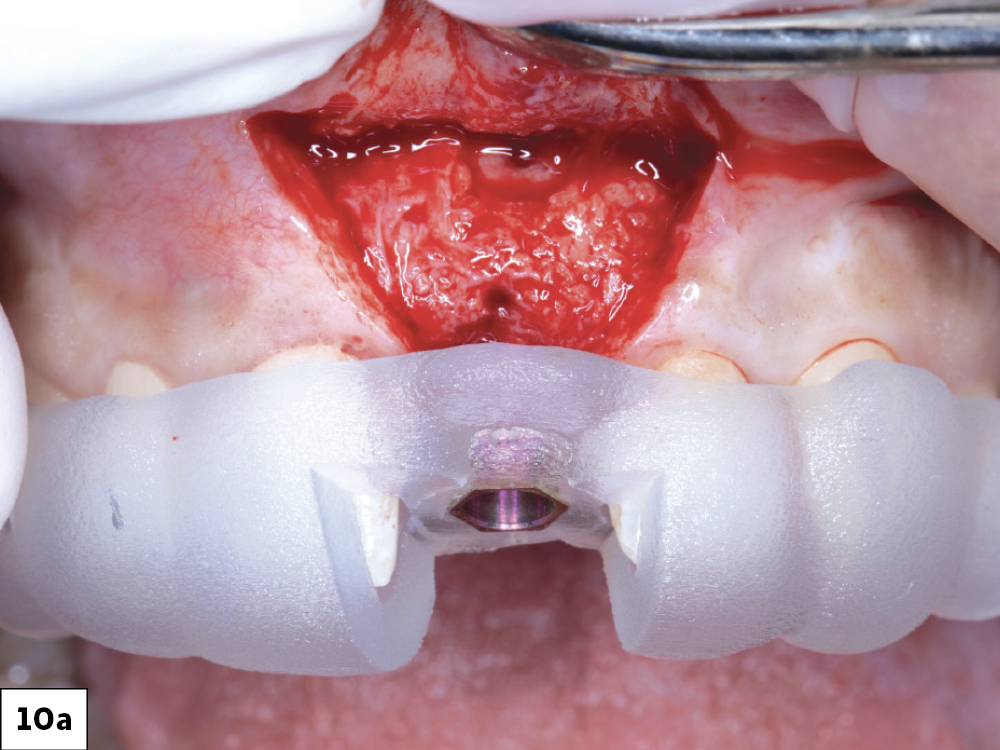 Teeth With Surgical Guide
