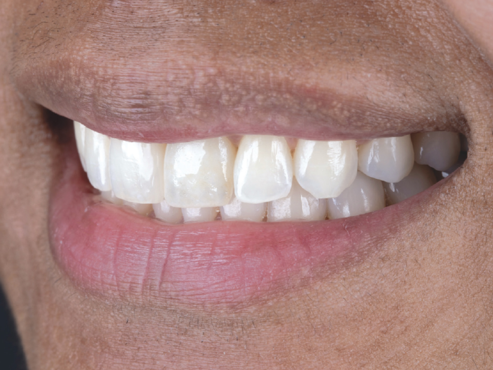lose-up of a smiling mouth with teeth