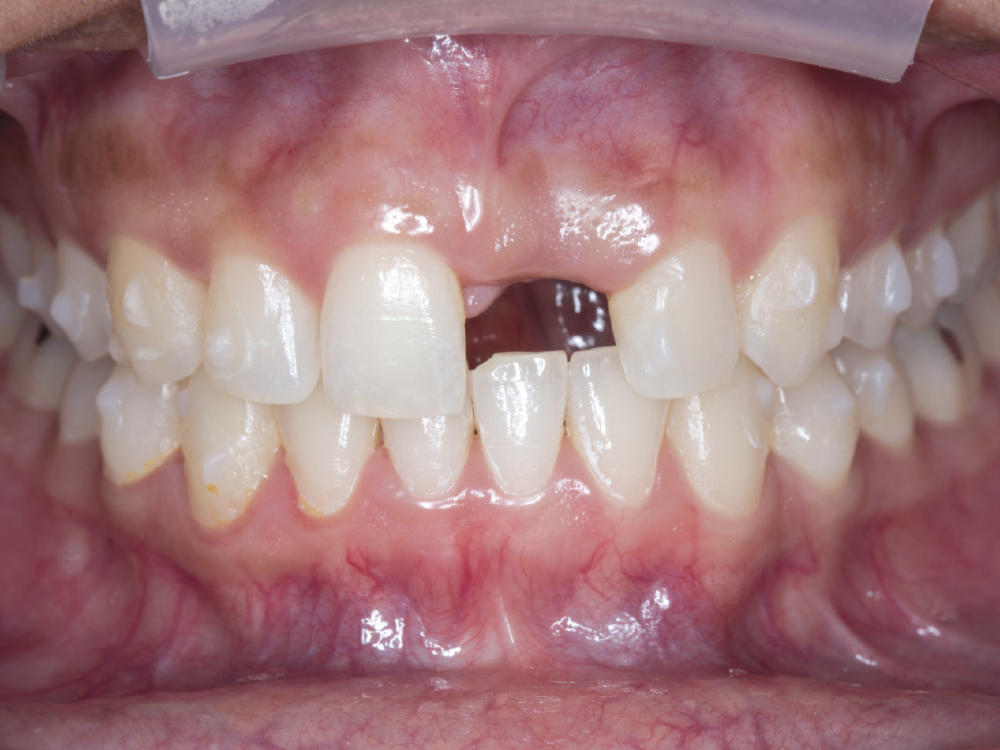 Close-up of missing front tooth
