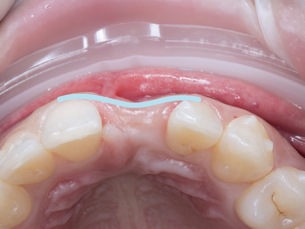 Close-up of dental arch with oral appliance