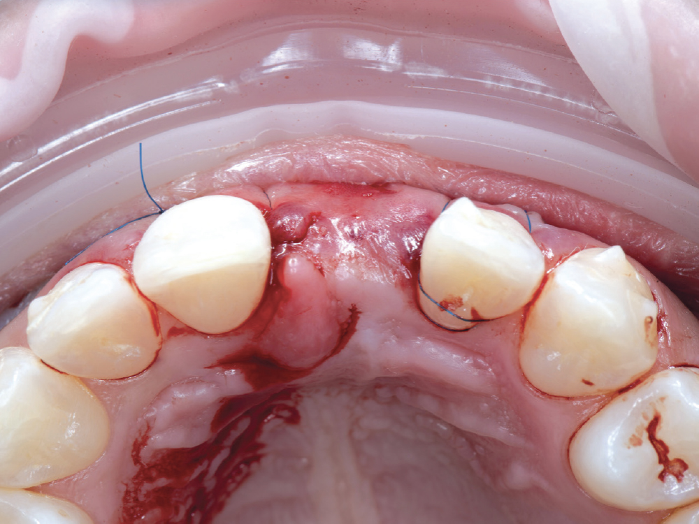 Soft tissue grafting
