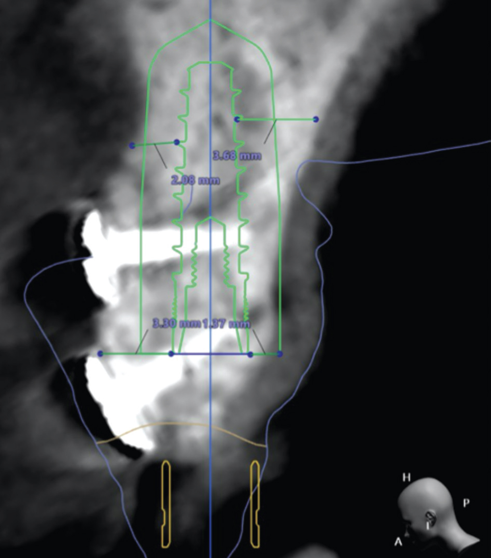 Dental X-ray with measurement overlays