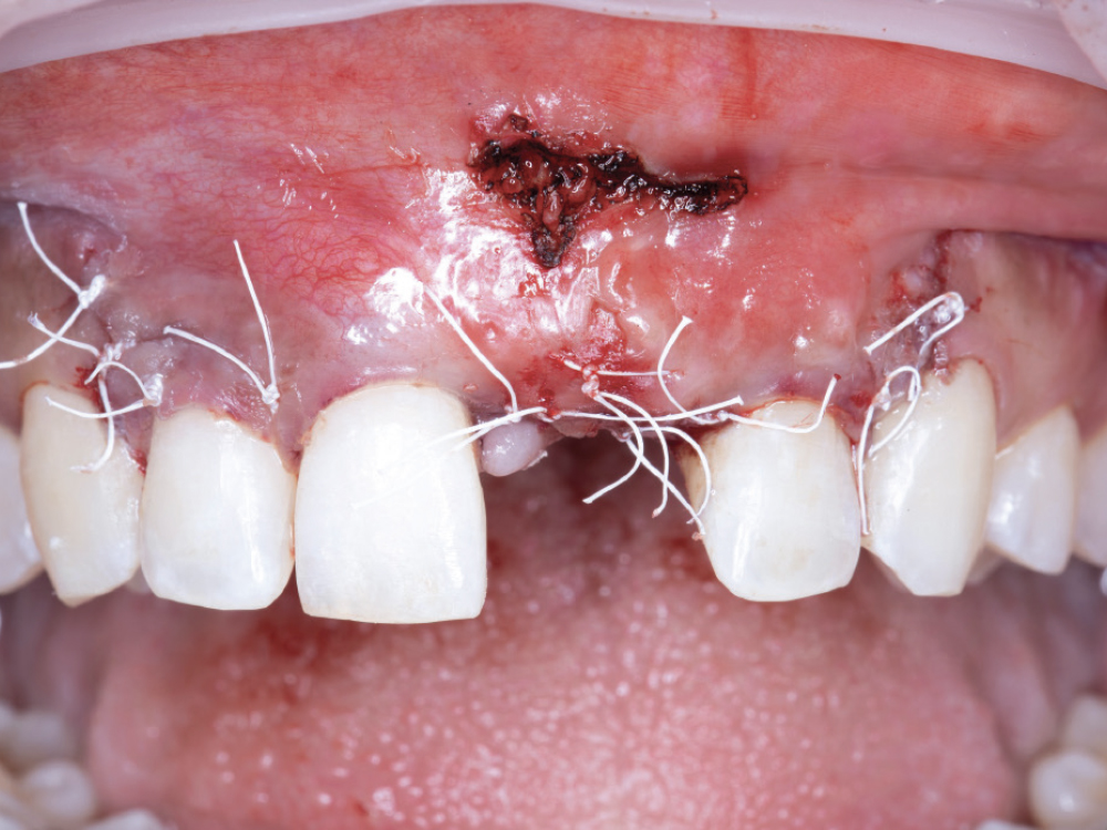 Close-up of dental surgery stitches