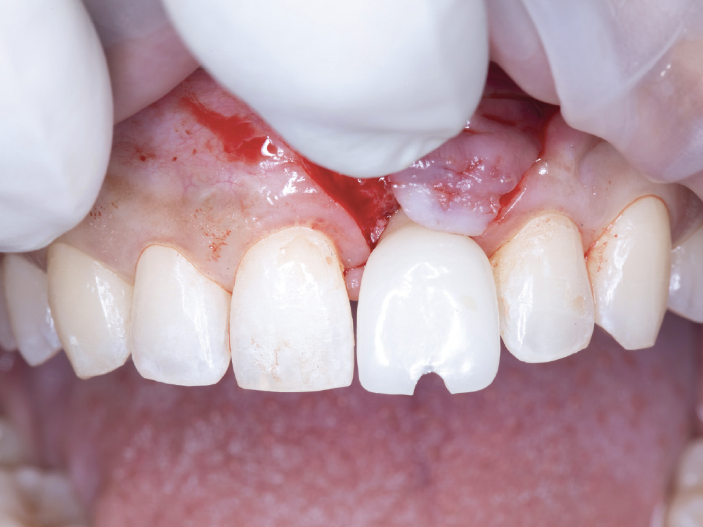 Provisional Restorations