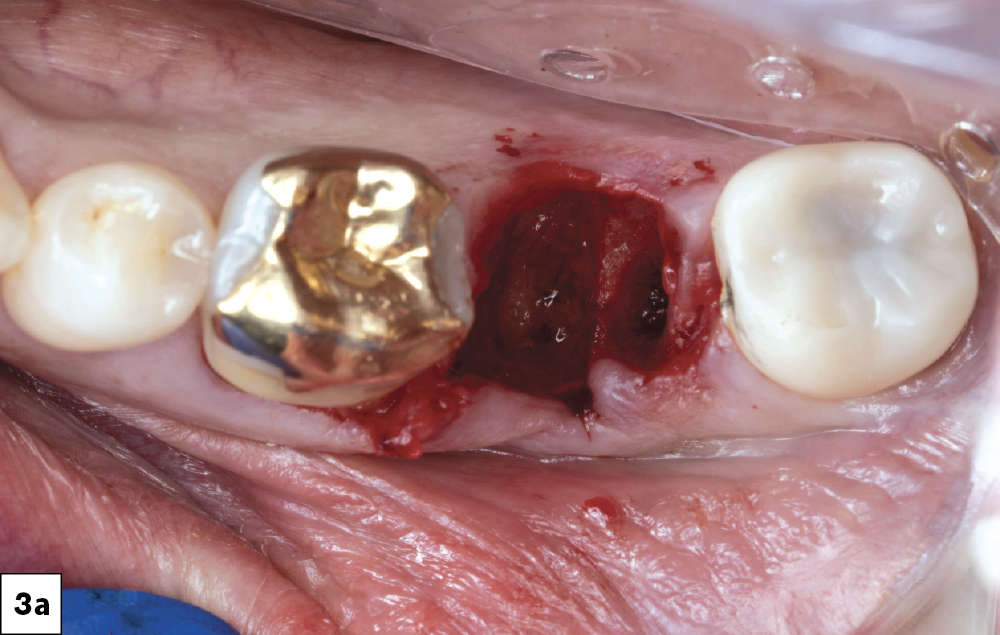 Tooth #18 extracted