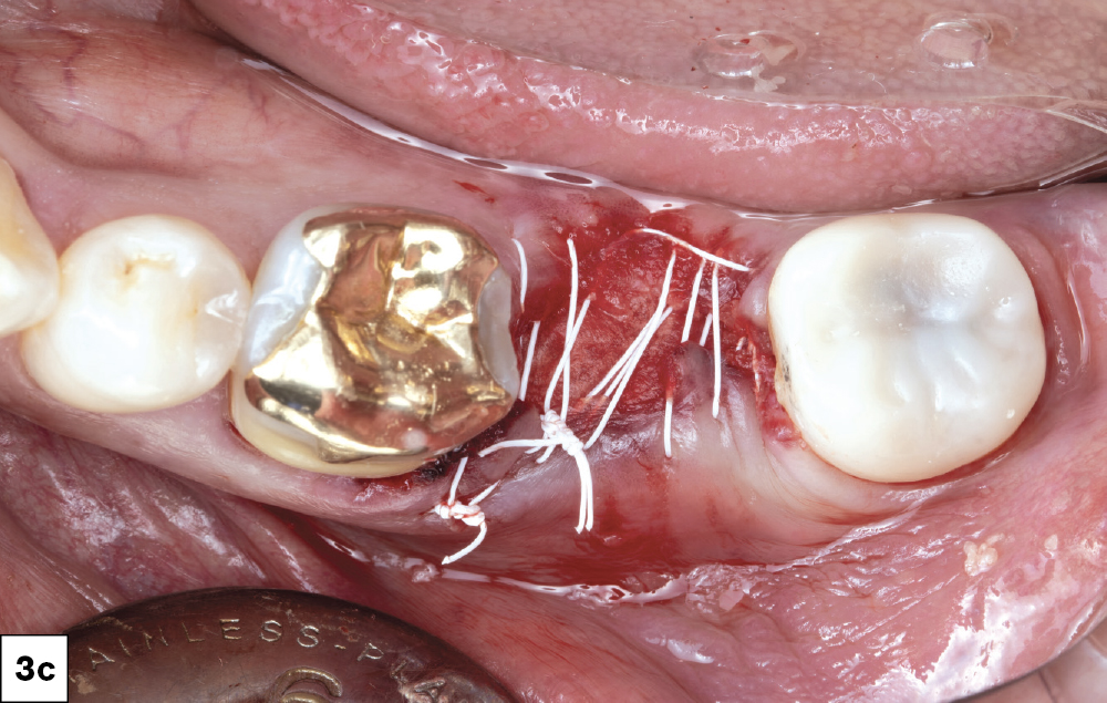 Stitched #18 socket