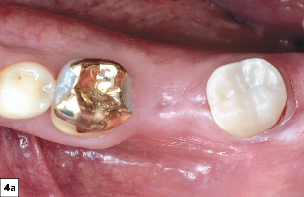 4 months after tooth extraction (top view)
