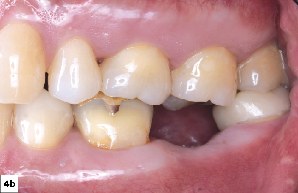 4 months after tooth extraction (side view)