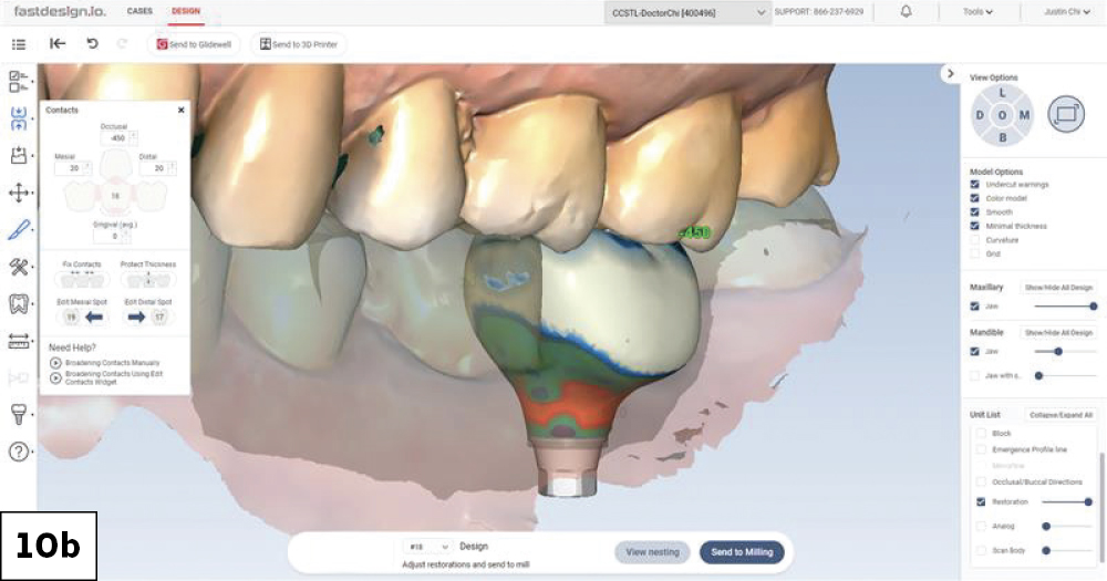 fastscan.io implant scan (side view)