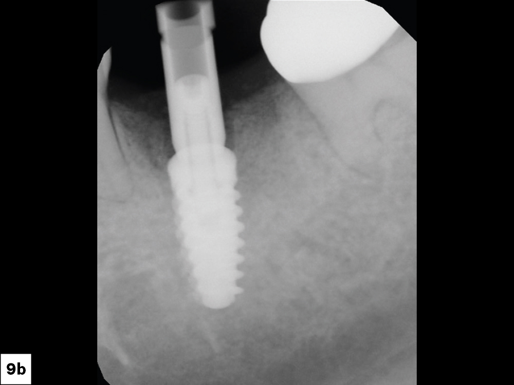 Inclusive® Titanium Scan Body in radiograph
