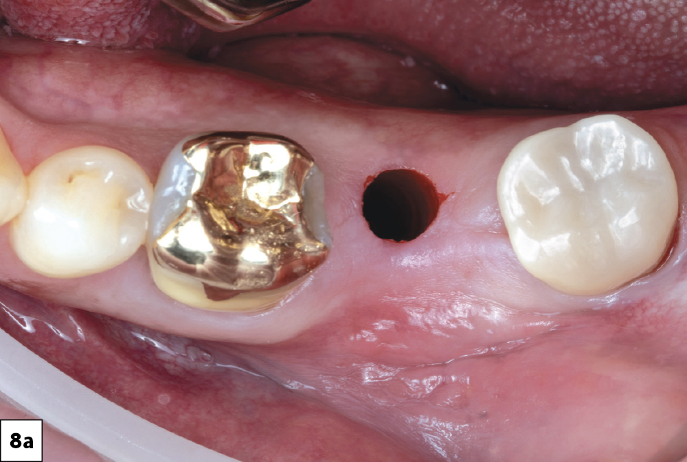 Tissue punch in socket #18