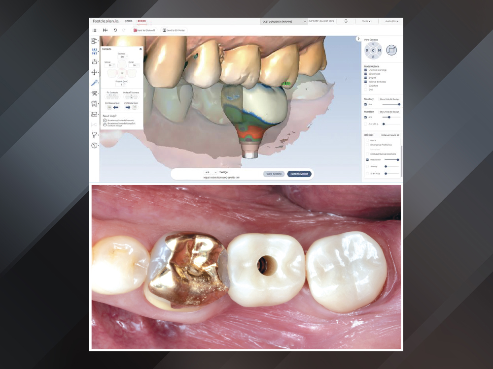 Single-Unit Implant Restoration Milled with BruxZir NOW SRC Single-Unit Implant Restoration Milled with BruxZir NOW SRC