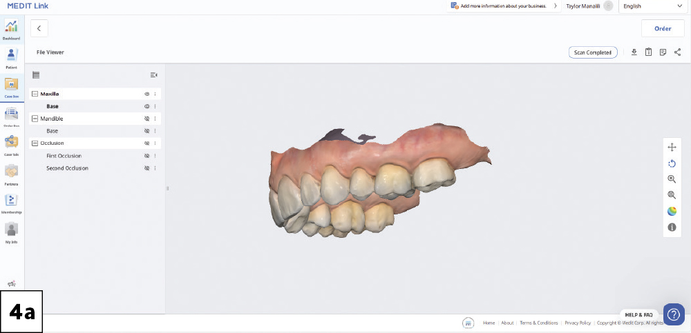 A pretreatment scan of the maxillary and mandibular arches and bite was done prior to delivery of local anesthetic-1