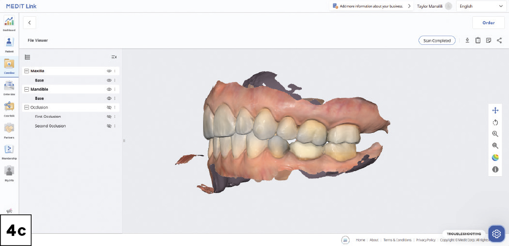 A pretreatment scan of the maxillary and mandibular arches and bite was done prior to delivery of local anesthetic-3