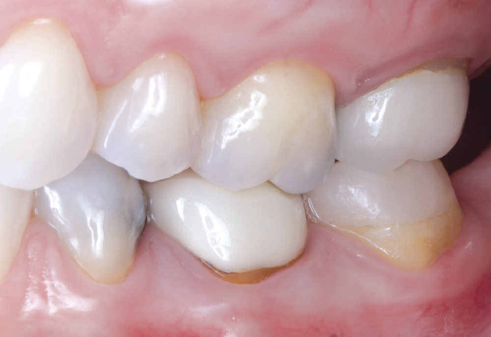 The patient’s chief concern was an open mesial margin of the crown on tooth #15