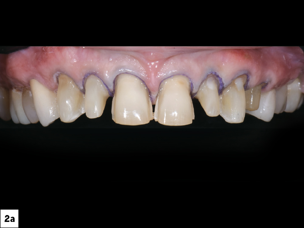 Preparations were completed for teeth #6–12