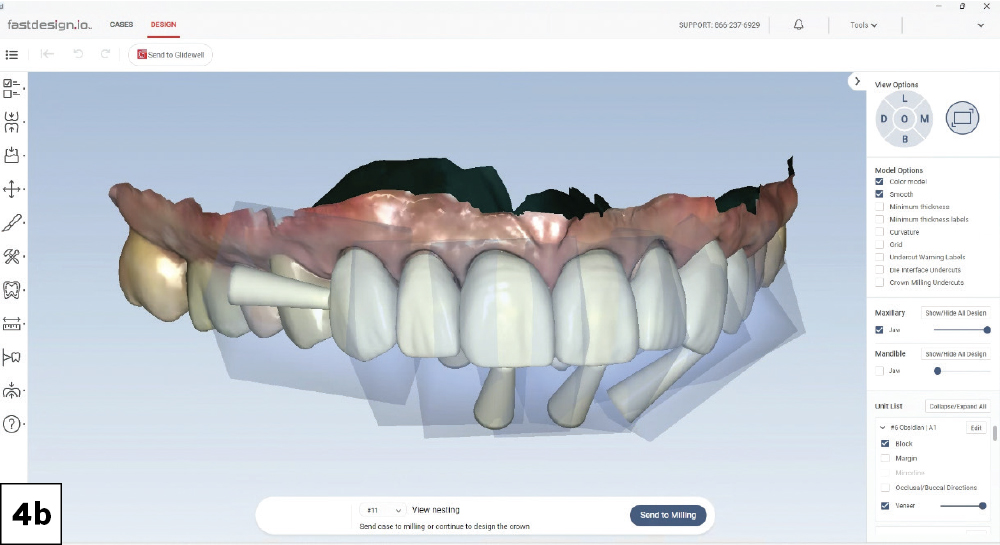 The margin positions were identified for each prep, and the software presented crown proposals using AI