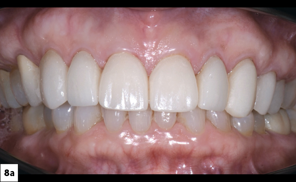he gingivectomy on #8 & #9 resulted in gingival symmetry