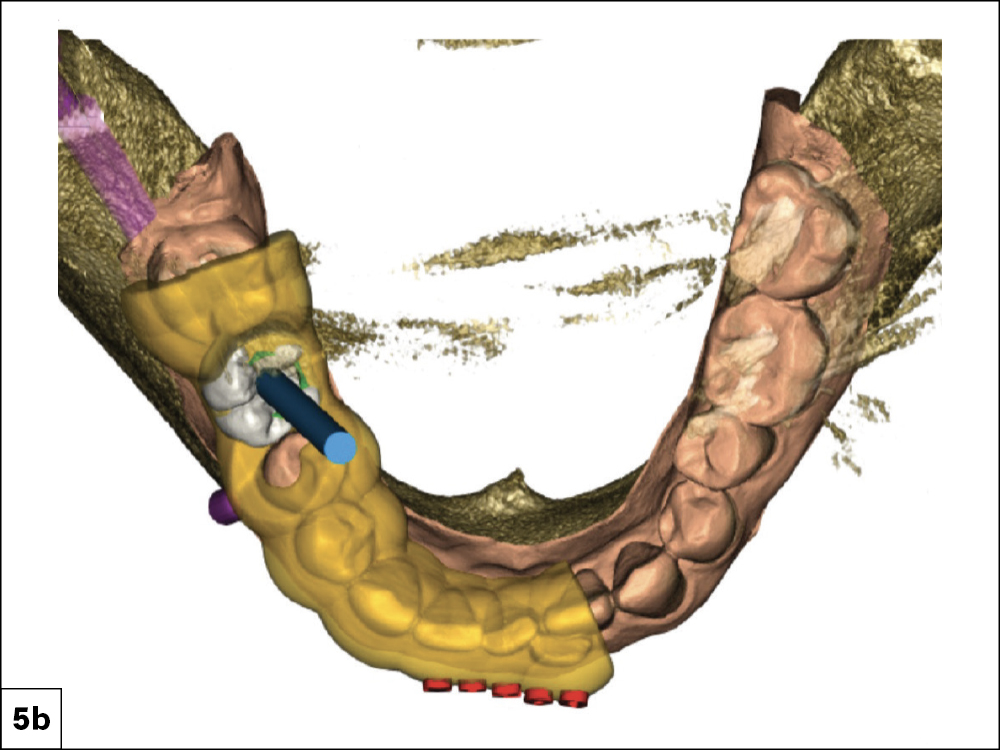 Detailed Surgical Report Revealing Distance to Vital Structures