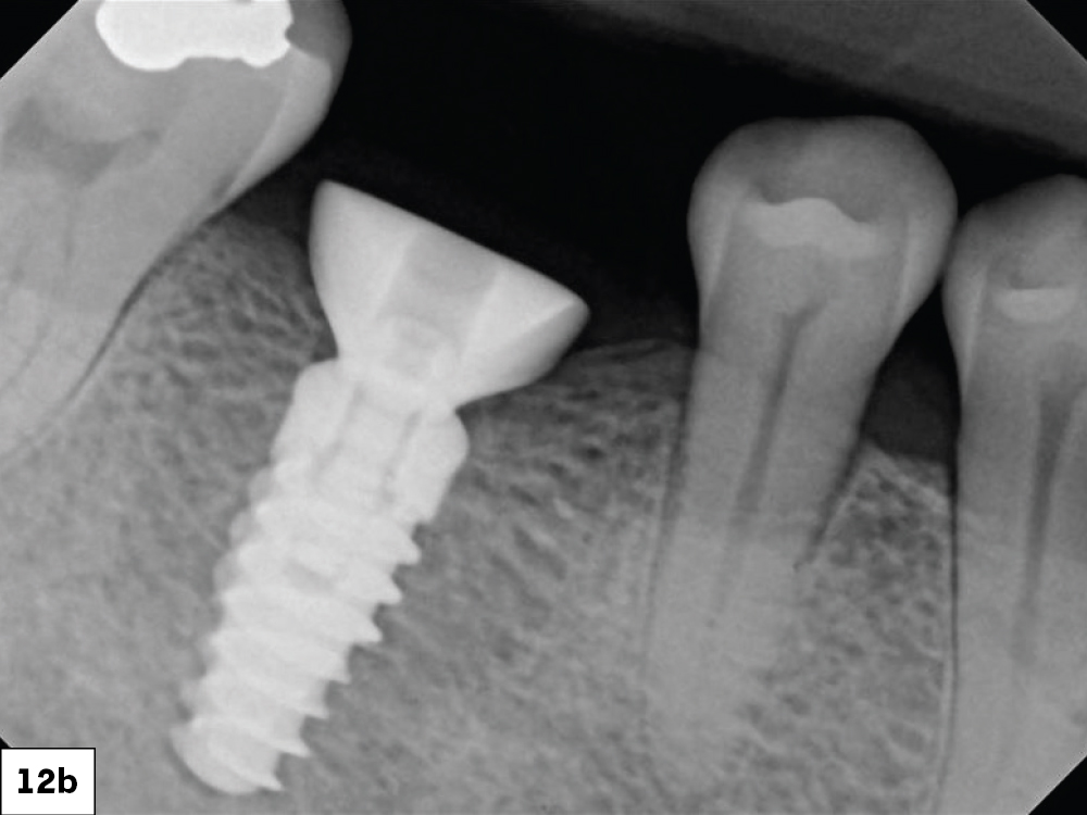 X-Ray of the Fully Inserted Implant Screw