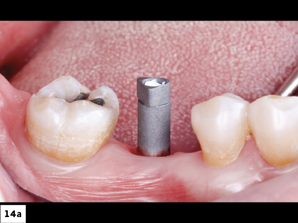 Glidewell HT Implant Titanium Scan Body Placement