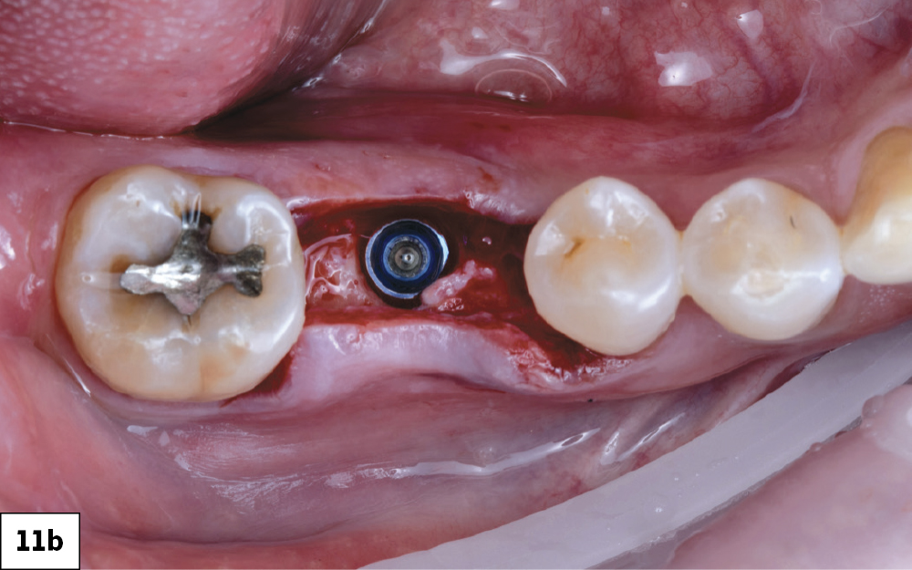 Implant Torqued to 35 Ncm