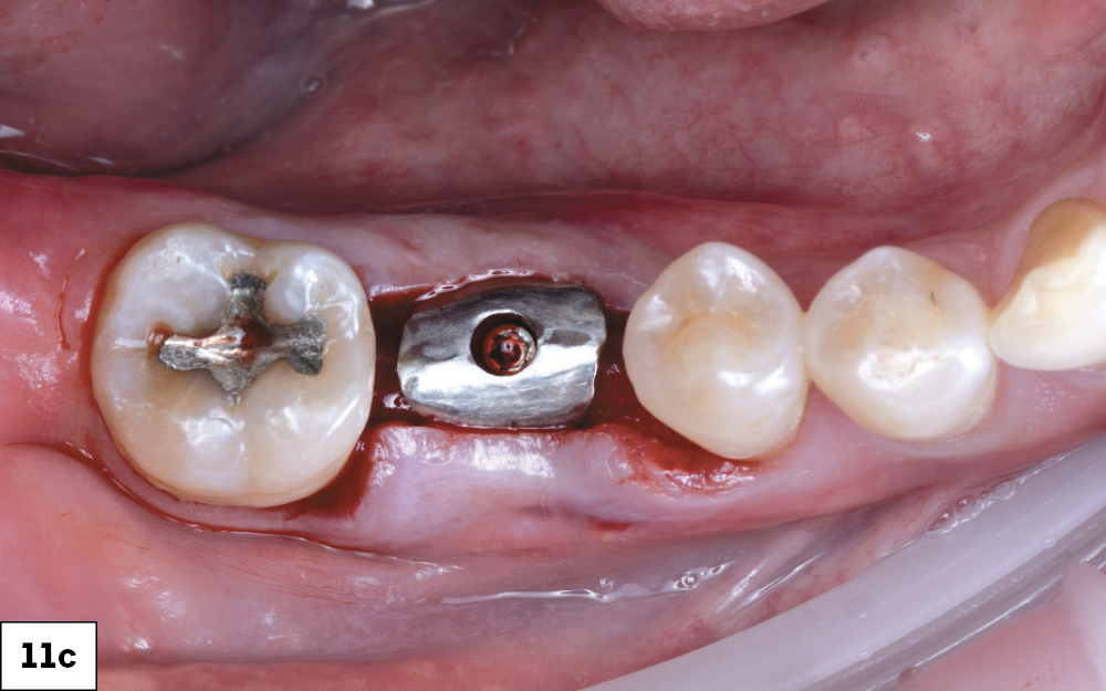 Glidewell Custom Healing Abutment Fully Seated