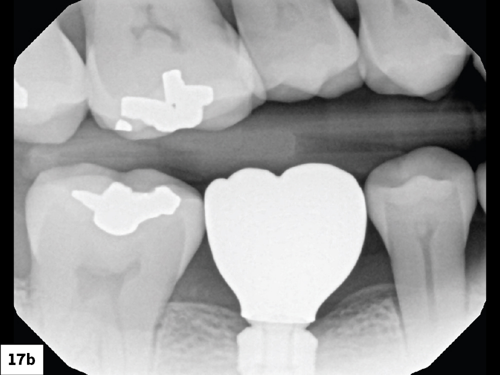 Access Channel Filled with Teflon Tape