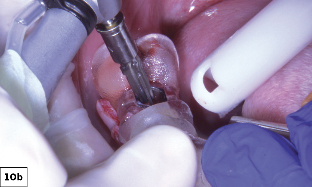 Insertion of 5 x 11.55mm Glidewell HT Implant