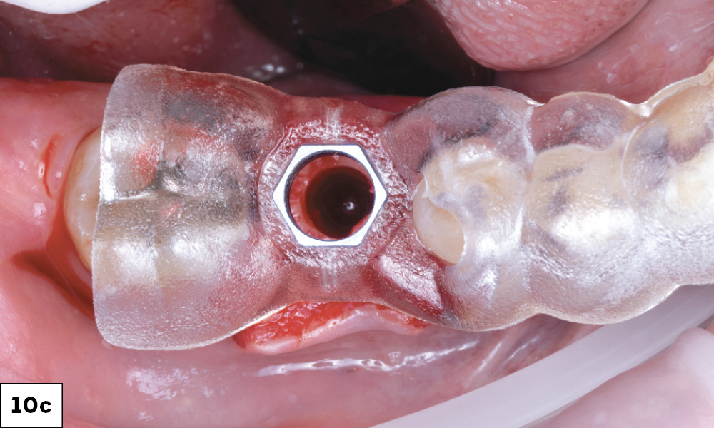 Completed Osteotomy and Fully Visible Through Surgical Guide