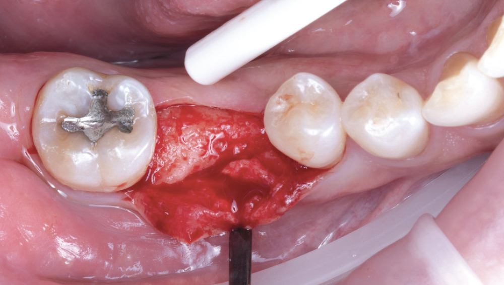 Reflection of Full-Thickness Flap While Preserving Keratinized Tissue