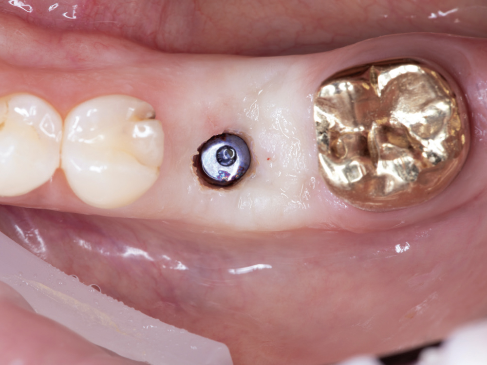 Soft-Tissue Contouring