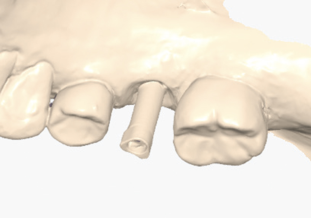 Implant post scan pointing down