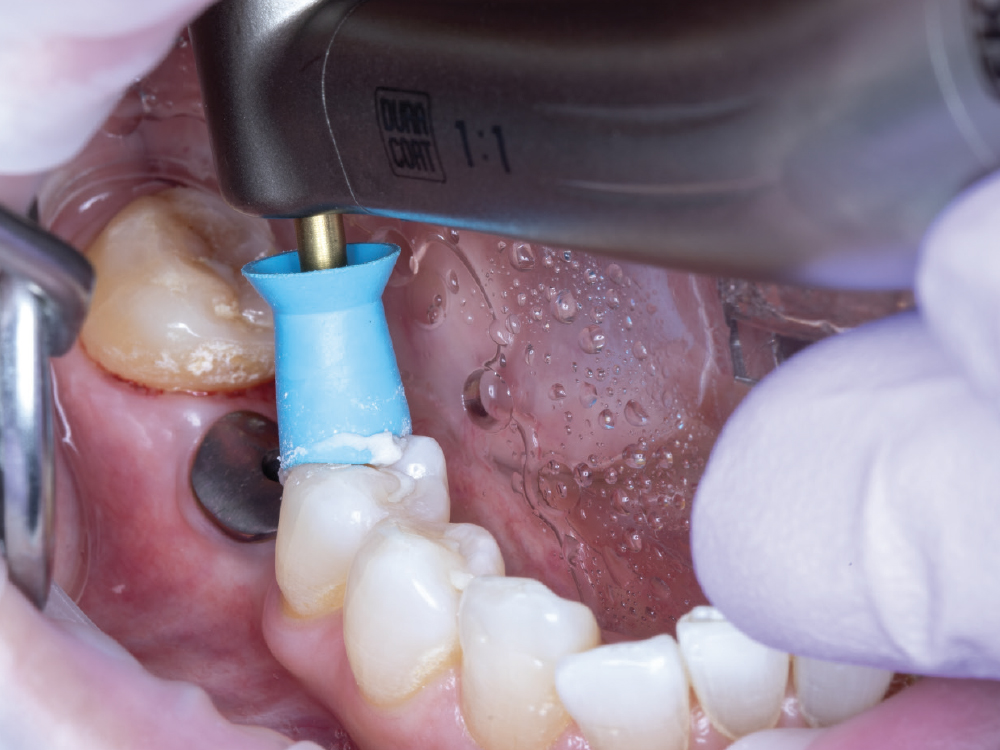 Clean Adjacent Teeth