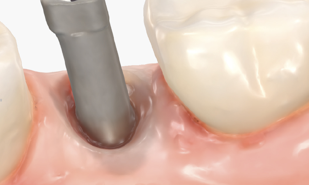 Capture the Surrounding Soft Tissue Immediately