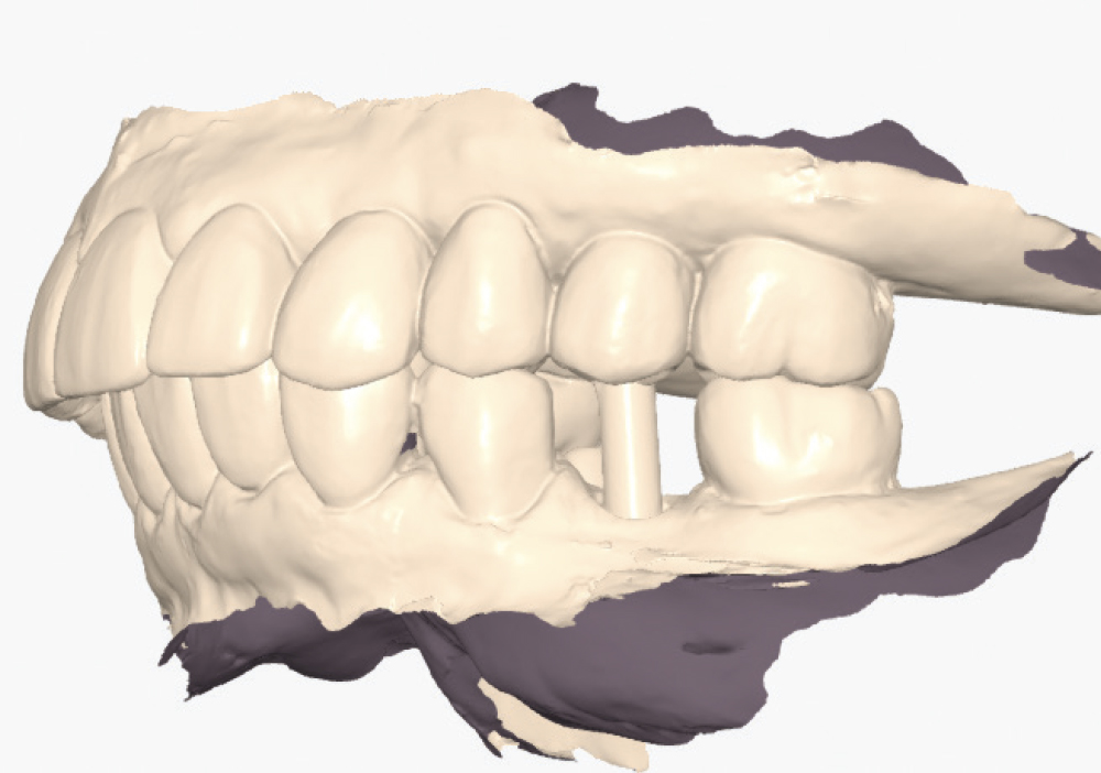 Implant post scan on left side of mouth