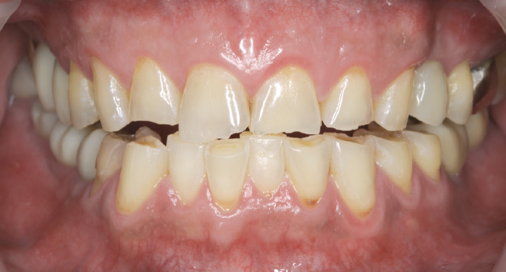 Assess Parafunctional Habits